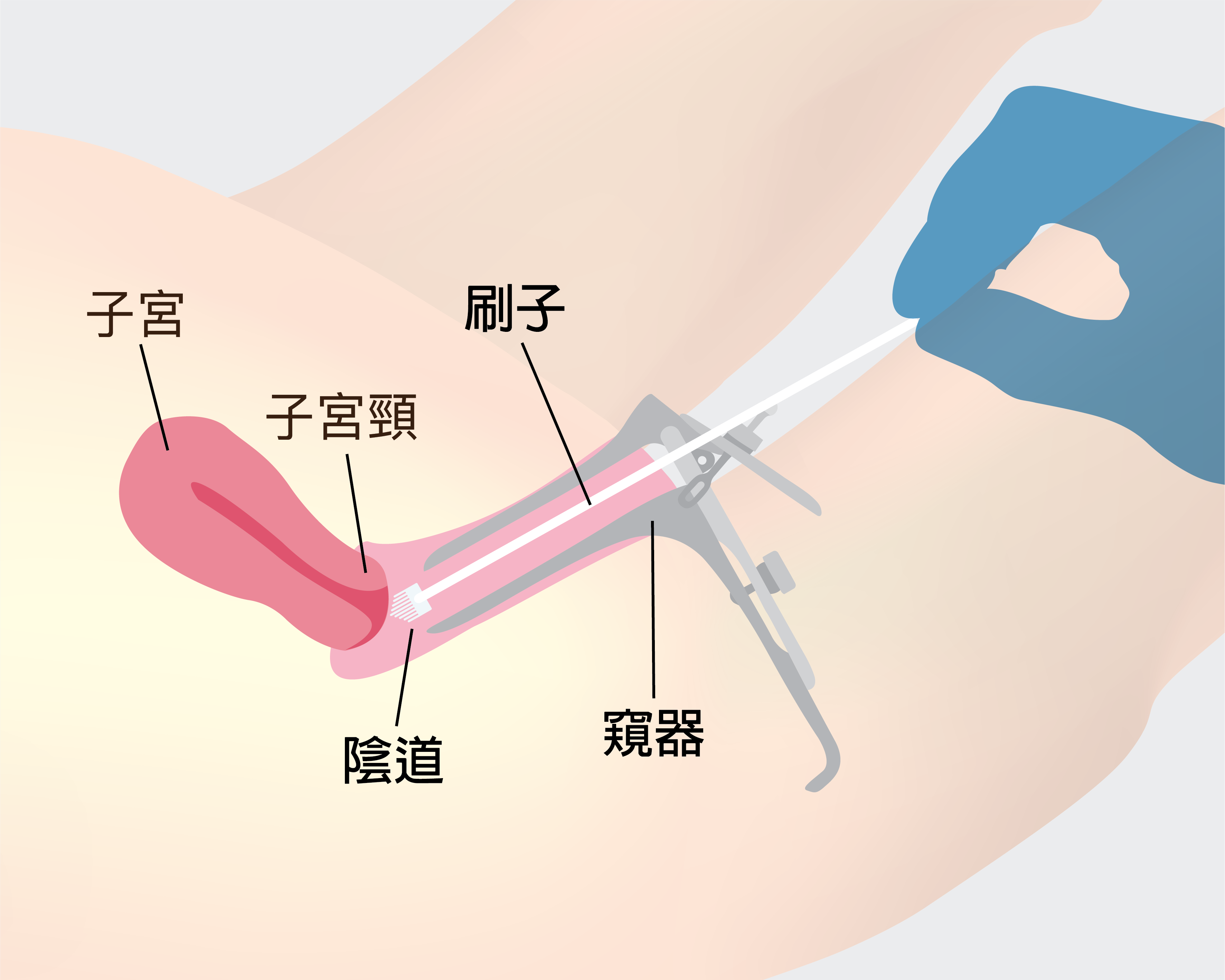 How cervical screening is done